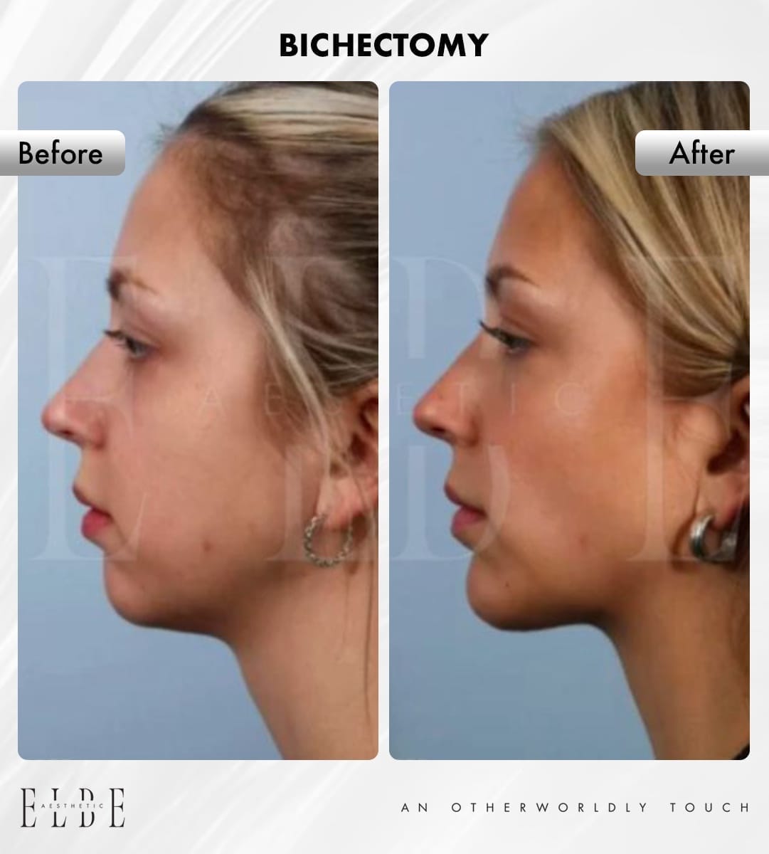 Modelowanie policzków